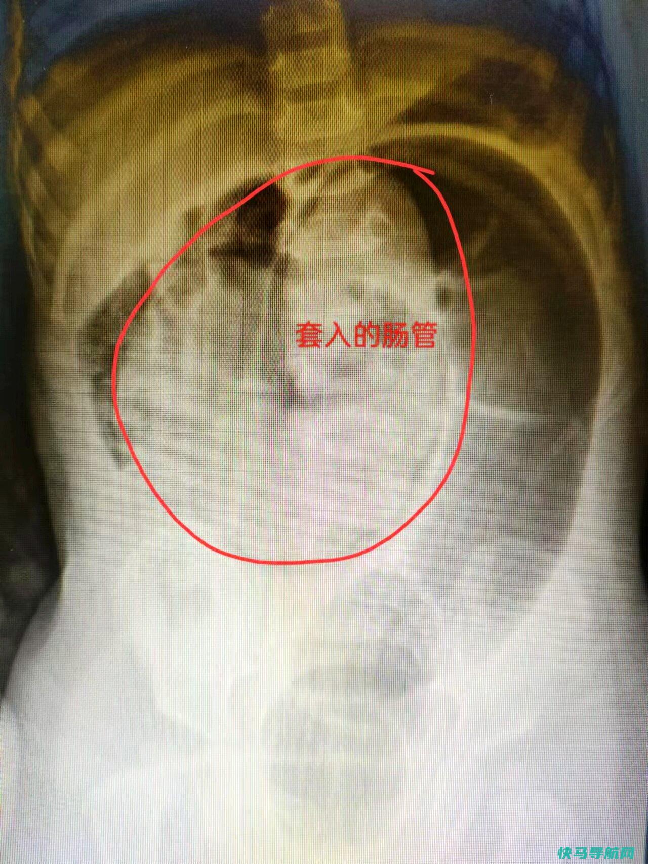 肠套叠灌完肠后5天不排便