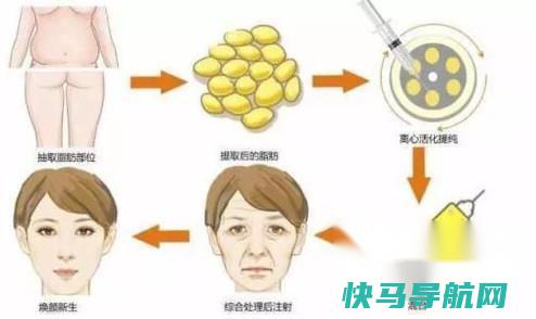 自体脂肪填充 第2张